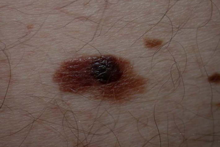 imagen con mancha en la piel por cancer