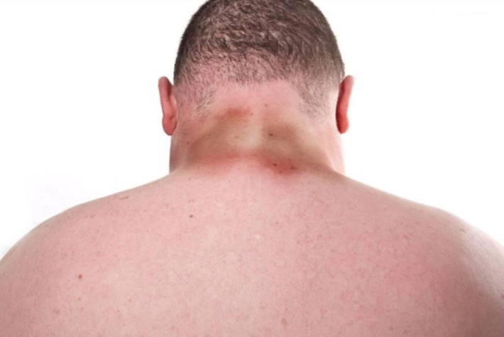 imagen hombre con manchas en la piel por diabetes en la espalda