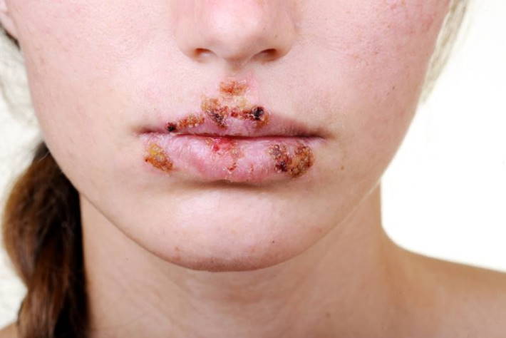 imagen de chica con manchas en la piel por vih sida en los labios