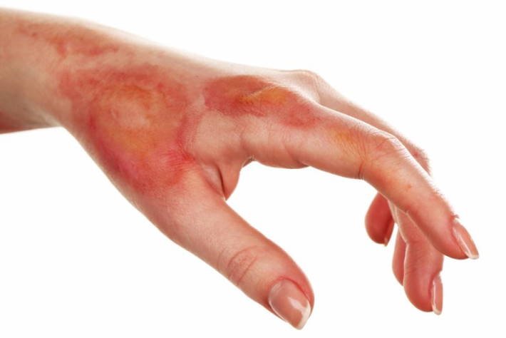 imagen manchas en la piel por quemaduras en una mano
